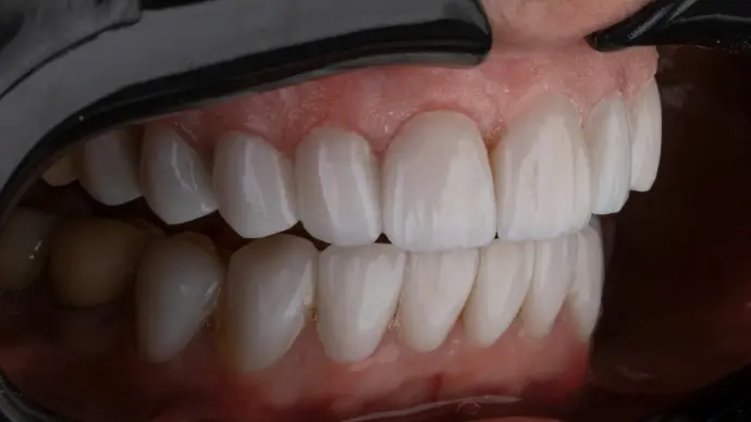 a person's mouth with teeth